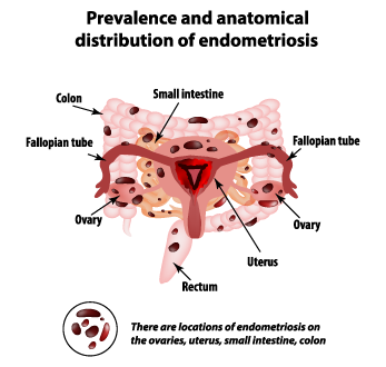 Common Sites of Endometriosis