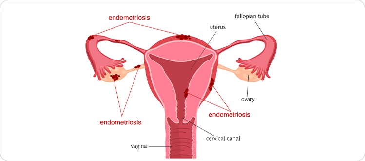 What is Endometriosis?