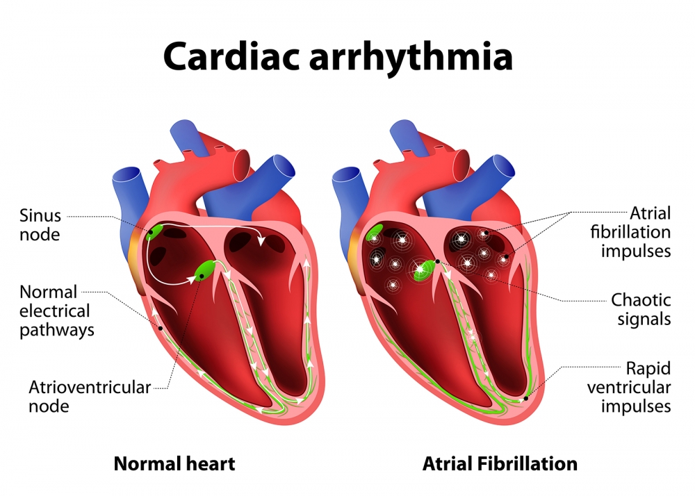 Understanding Arrhythmia: When Your Heart Skips a Beat