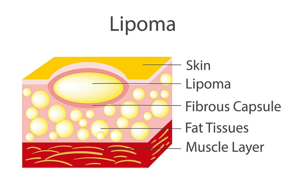 below Checking a lipoma at an early stage is always better.