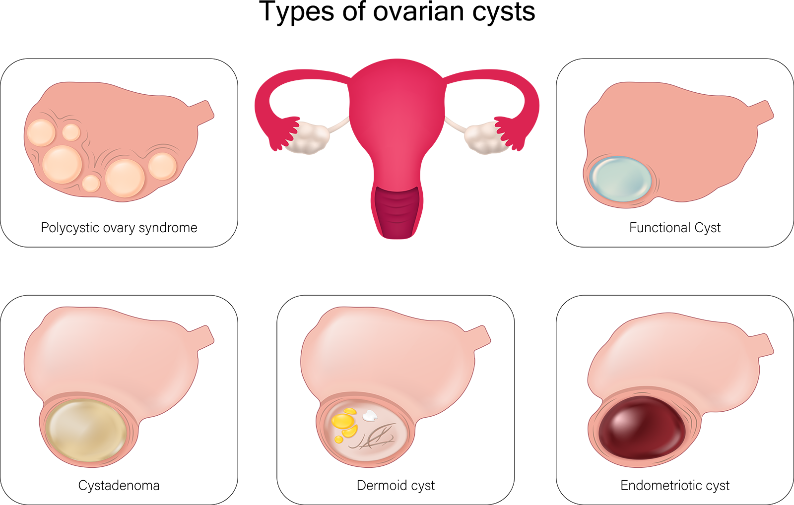 Types of Ovarian Cysts